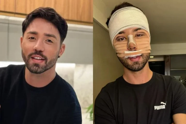 Influenciador Rico Melquiades detalha histórico de cirurgias e diz que seguirá com procedimentos